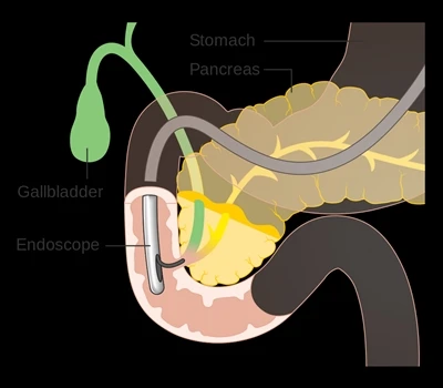 Mis on ERCP ja ERCP tooted?